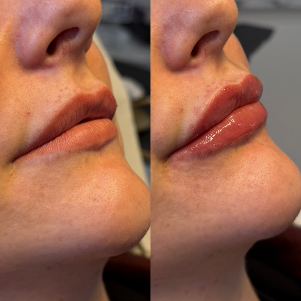 Before and after lip filler treatment by Lara at The Refresh Clinic