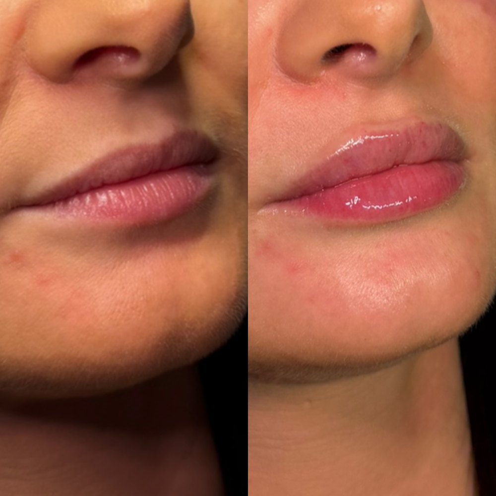Before and after lip filler treatment by Lara at The Refresh Clinic