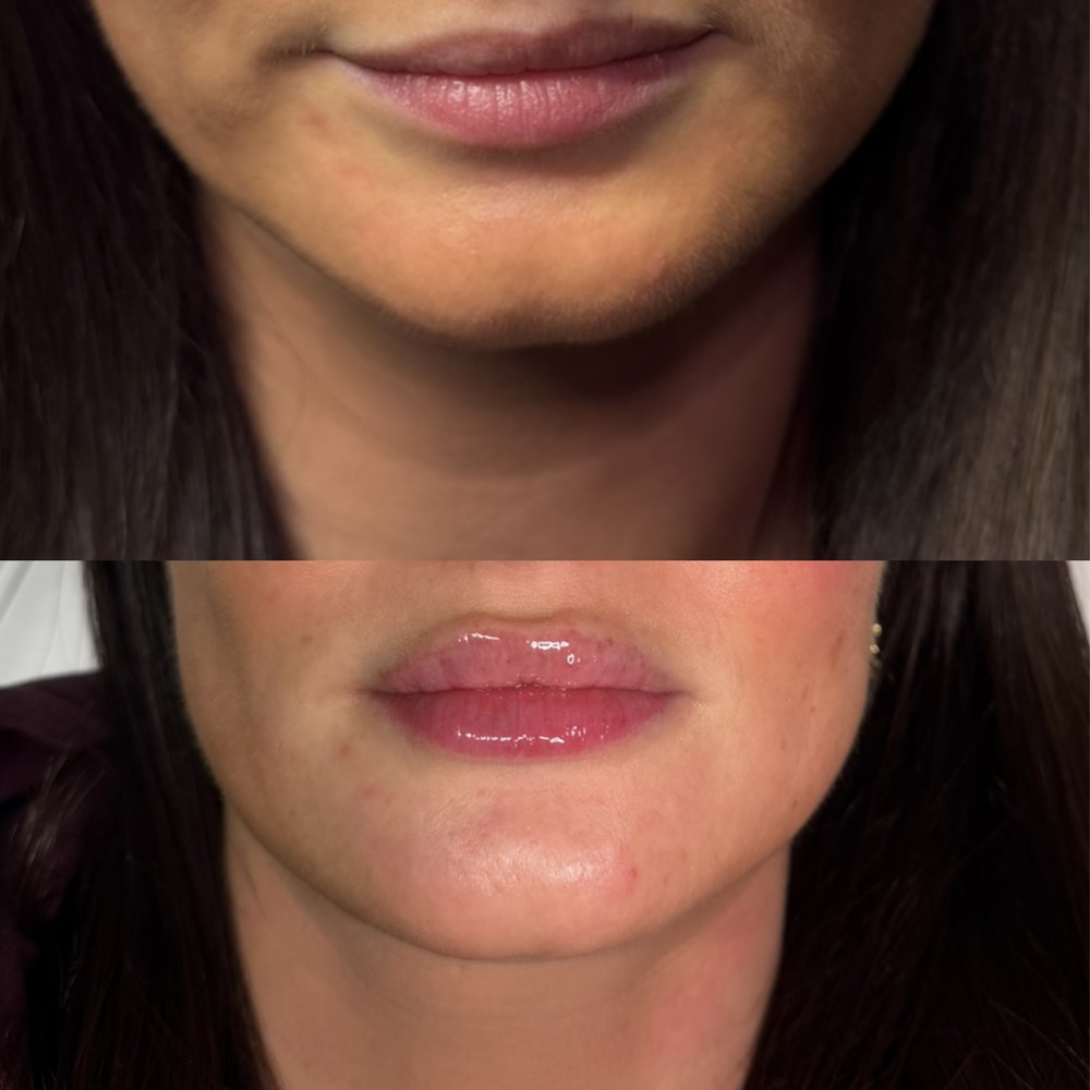 Before and after lip filler treatment by Lara at The Refresh Clinic